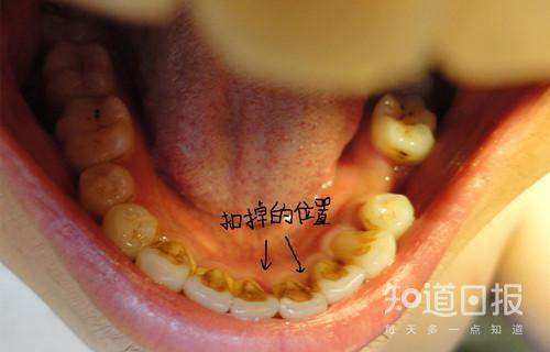 牙齿缝隙上黄怎么清理,牙齿内侧黑色的牙垢怎么清除图1