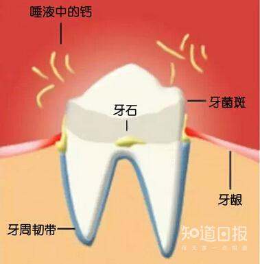 牙齿缝隙上黄怎么清理,牙齿内侧黑色的牙垢怎么清除图2