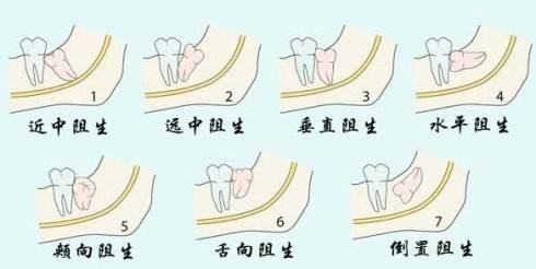 拔智齿后疼么 你真的知道,拔智齿疼不疼图1