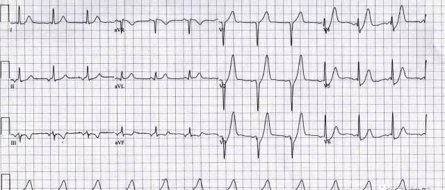 dewinter综合征心电图表现,wellens综合征图3