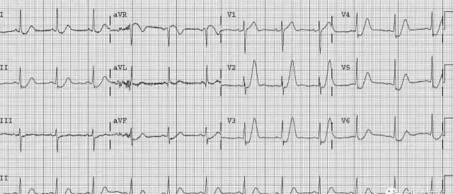 dewinter综合征心电图表现,wellens综合征图4