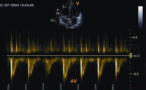 e峰大于a峰,二尖瓣血流频谱e峰大于a峰是什么意思图3
