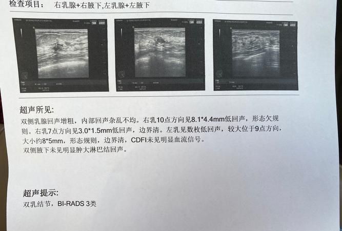 乳腺结节乳钙化怎么办,检查乳腺增生需要空腹图2