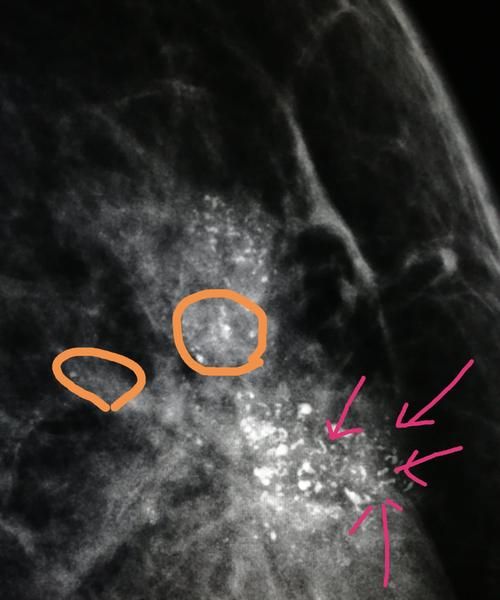 乳腺结节乳钙化怎么办,检查乳腺增生需要空腹图3