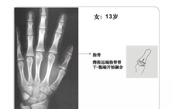 骨龄比实际年龄大怎么办,儿童骨龄偏小的原因图6