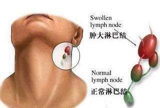 舌管囊肿有什么危害,舌根囊肿会导致打鼾睡觉不踏实图3