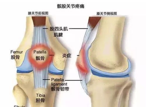 膝关节脱臼判断方法,膝关节脱臼图2