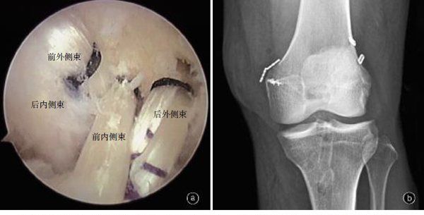 膝关节脱臼判断方法,膝关节脱臼图4