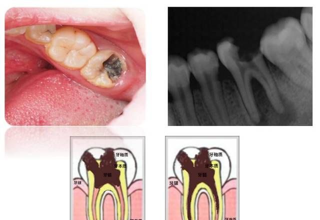 虫牙怎么办 蛀牙的成因,蛀牙是怎么样的 了解蛀牙的成因和预防措施图7