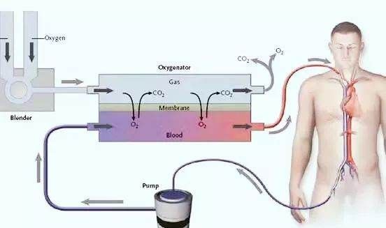 什么是ecmo设备,ecmo是什么仪器图3